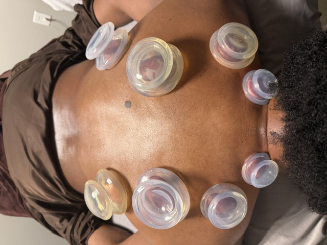Clear transparent therapy cups placed on a client's back during cupping therapy, no face showing